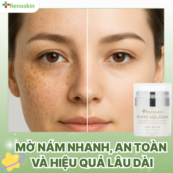 Kem mờ nám tàn nhang Renoskin White Melasma 30g – cải thiện thâm sạm, nám nhẹ, da không đều màu.
