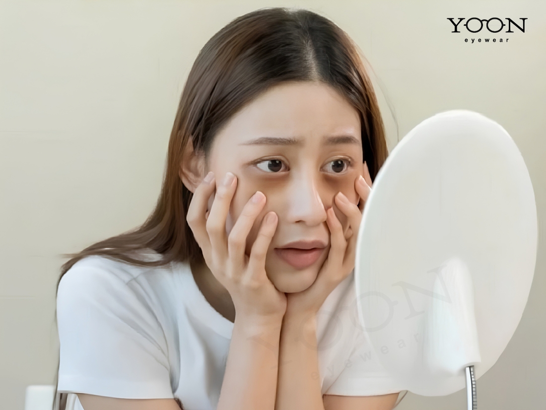 Bầm Mắt Không Rõ Nguyên Nhân