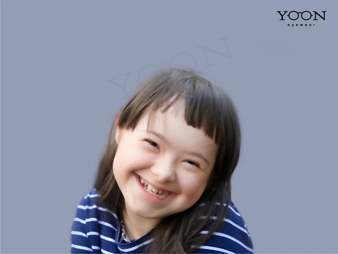 CÁC VẤN ĐỀ VỀ MẮT THƯỜNG GẶP Ở NGƯỜI MẮC HỘI CHỨNG DOWN