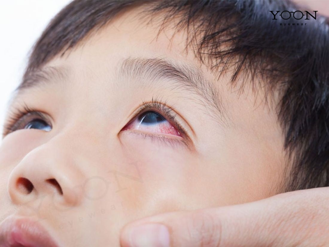CÁCH ĐIỀU TRỊ KHI LÒNG TRẮNG MẮT BỊ ĐỎ