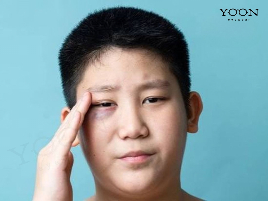 Dễ Bầm Do Thuốc Hoặc Rối Loạn Đông Máu