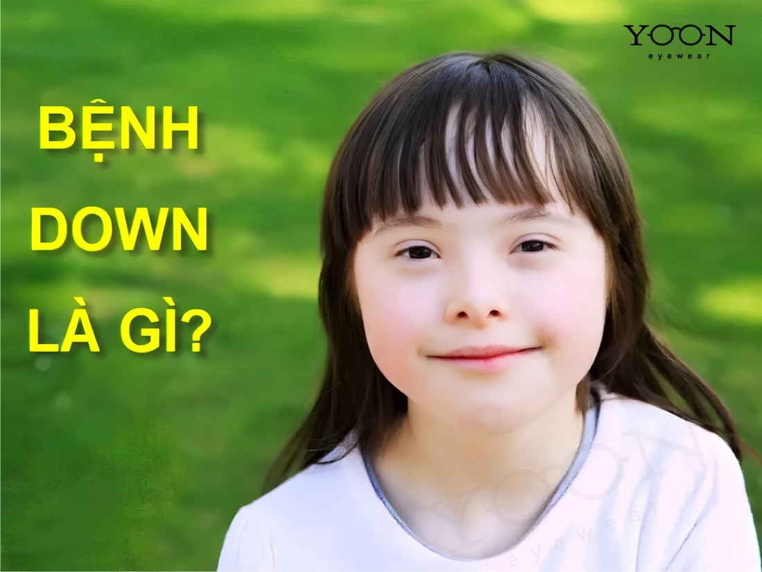 HỘI CHỨNG DOWN LÀ GÌ?