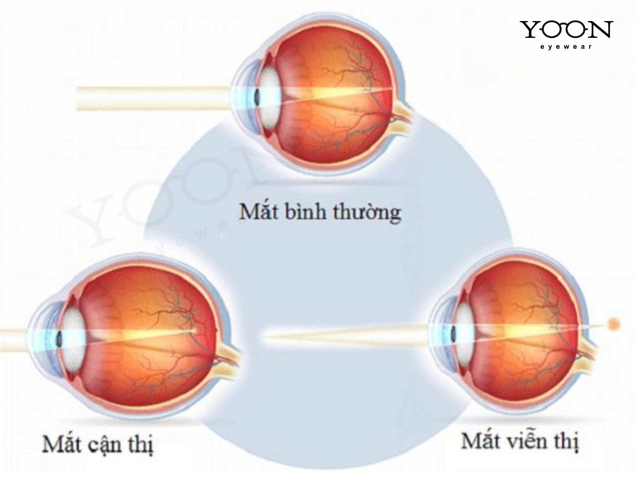 KÍNH VIỄN THỊ LÀ GÌ?