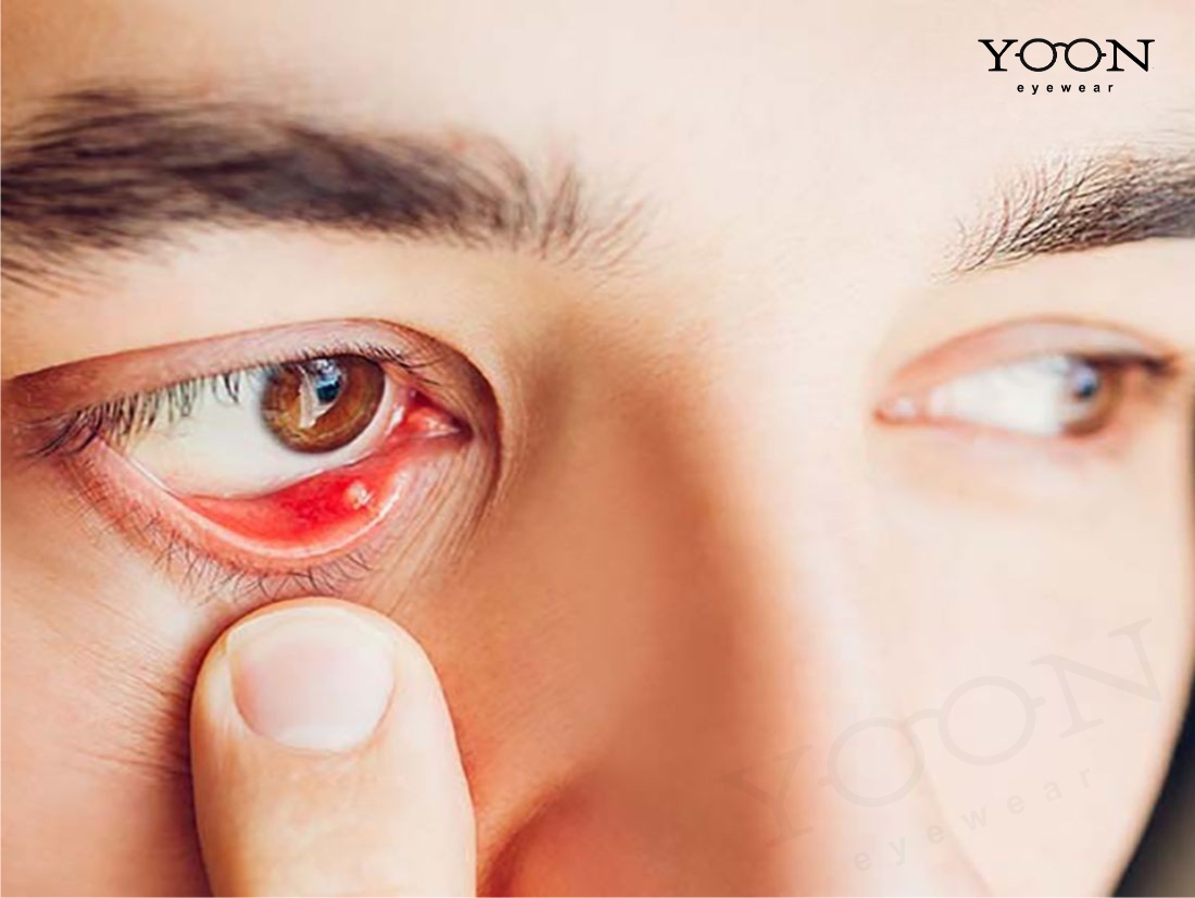 LẸO MẮT LÀ GÌ?
