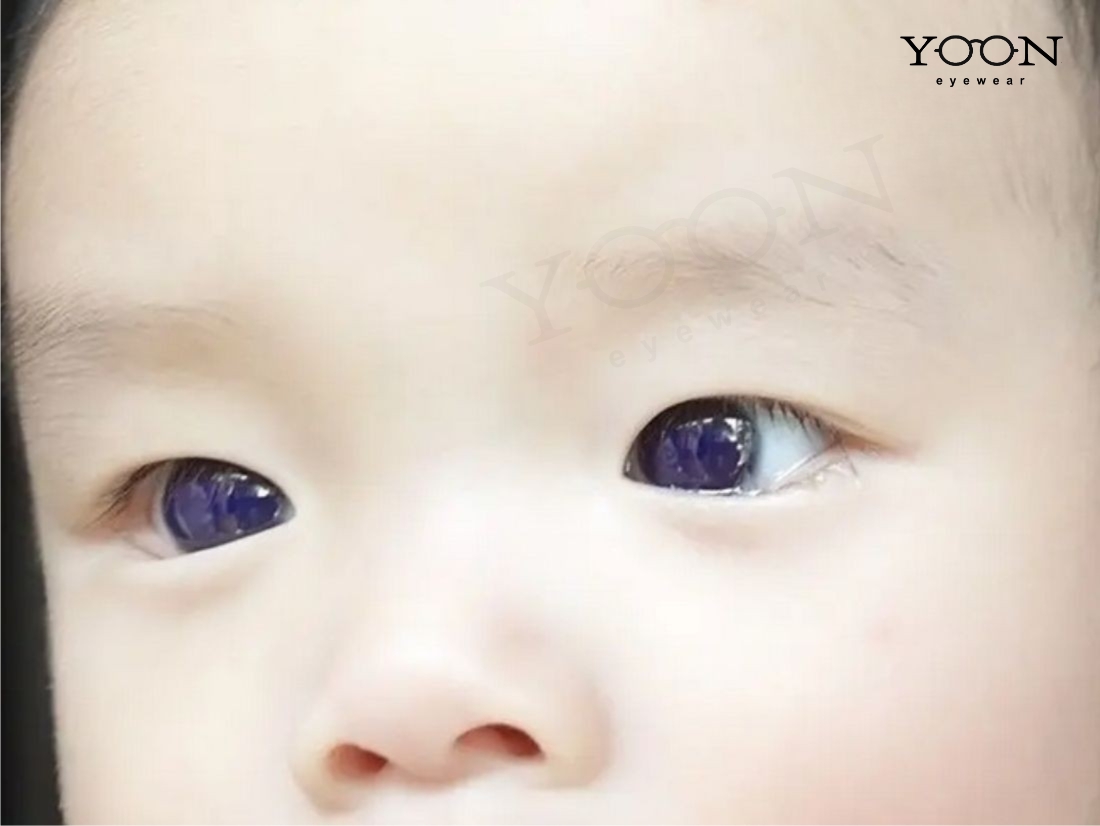 Mù màu hoàn toàn bẩm sinh (Congenital Achromatopsia)
