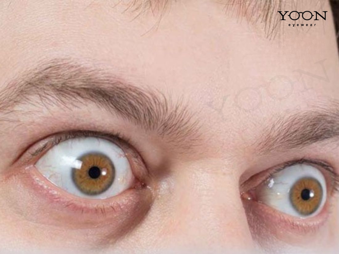 MẮT LỒI CÓ PHẢI LÚC NÀO CŨNG LÀ BỆNH