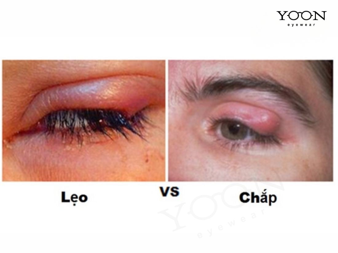 NHỮNG AI DỄ BỊ CHẮP HOẶC LẸO?
