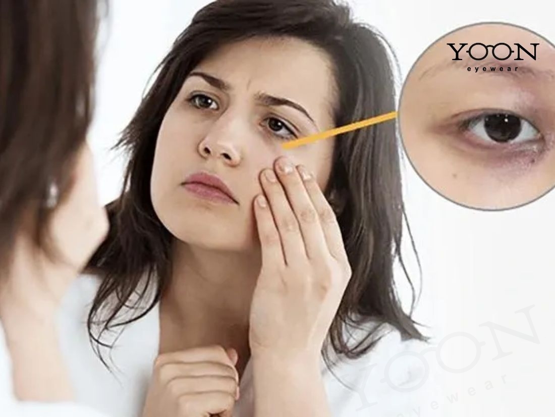 Quầng Thâm Hỗn Hợp