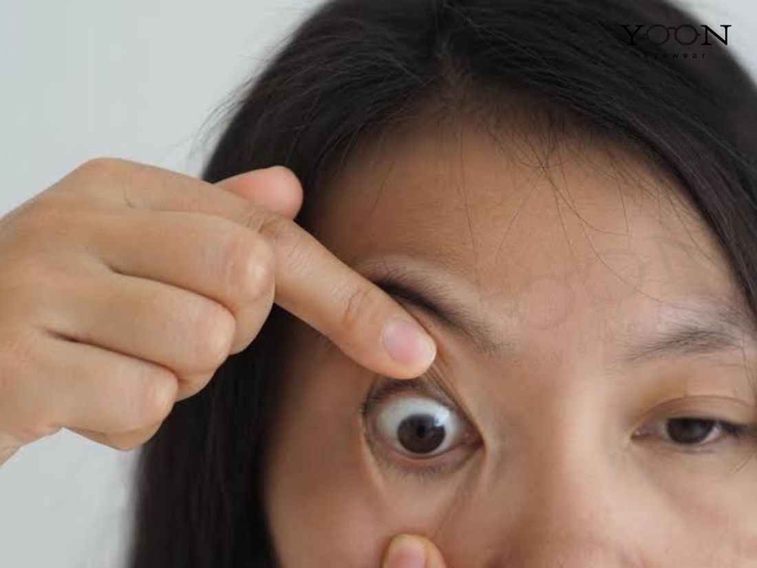 VÌ SAO MẮT LỘ THẦN DỄ BỊ NHẦM VỚI MẮT LỒI?