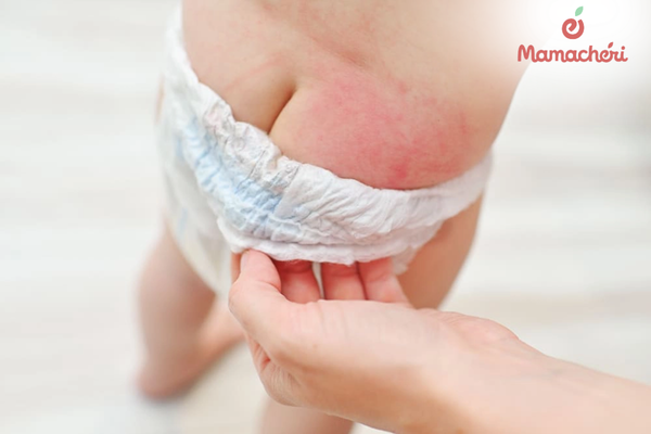 Dấu hiệu nhận biết hăm tã ở trẻ qua vùng da bị đỏ