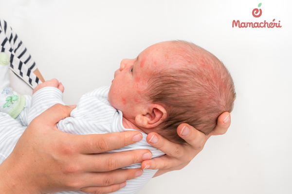 Các nguyên nhân thường gặp khiến trẻ bị dị ứng nổi mẩn đỏ và ngứa