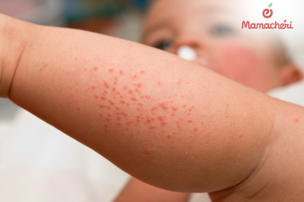 Cách phòng ngừa rôm sảy cho trẻ sơ sinh