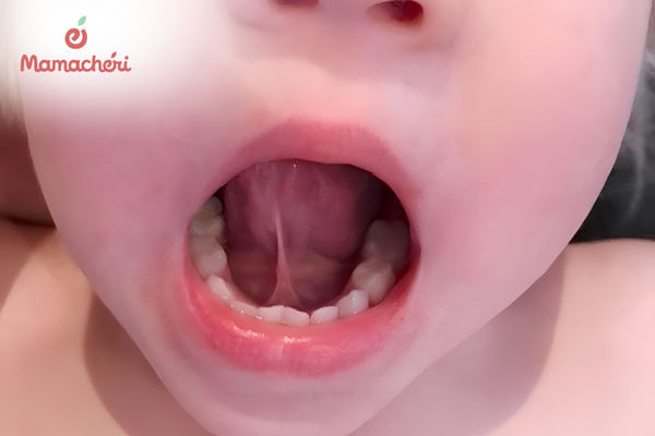 Dính thắng lưỡi ở trẻ là tình trạng dây thắng lưỡi ngắn hoặc bám bất thường