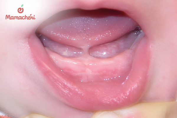 Nguyên nhân dính thắng lưỡi ở trẻ và các yếu tố liên quan