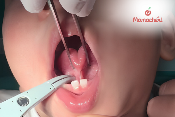 Các phương pháp điều trị dính thắng lưỡi ở trẻ