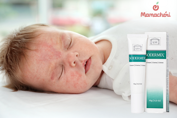 Kem Sodermix Cream hỗ trợ chăm sóc làn da trẻ bị chàm sữa