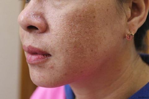 Tạm biệt thâm nám, da trắng rạng rỡ cùng Glutathione