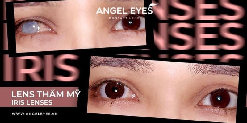 Mắt lác có đeo lens được không