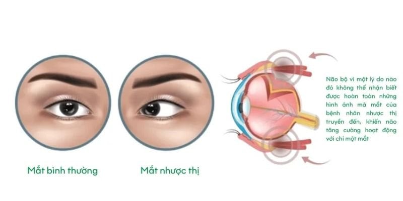 Nhược thị nên dùng loại lens nào?