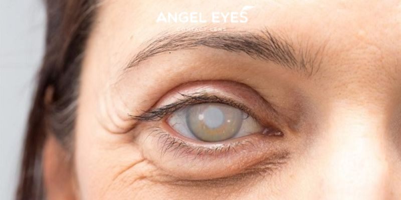 Nguyên nhân gây nhược thị ở mắt