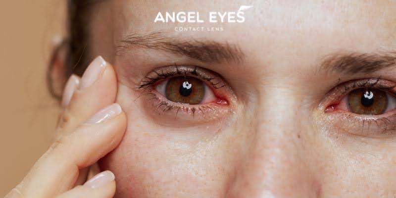 Lưu ý cho mắt yếu khi đeo lens