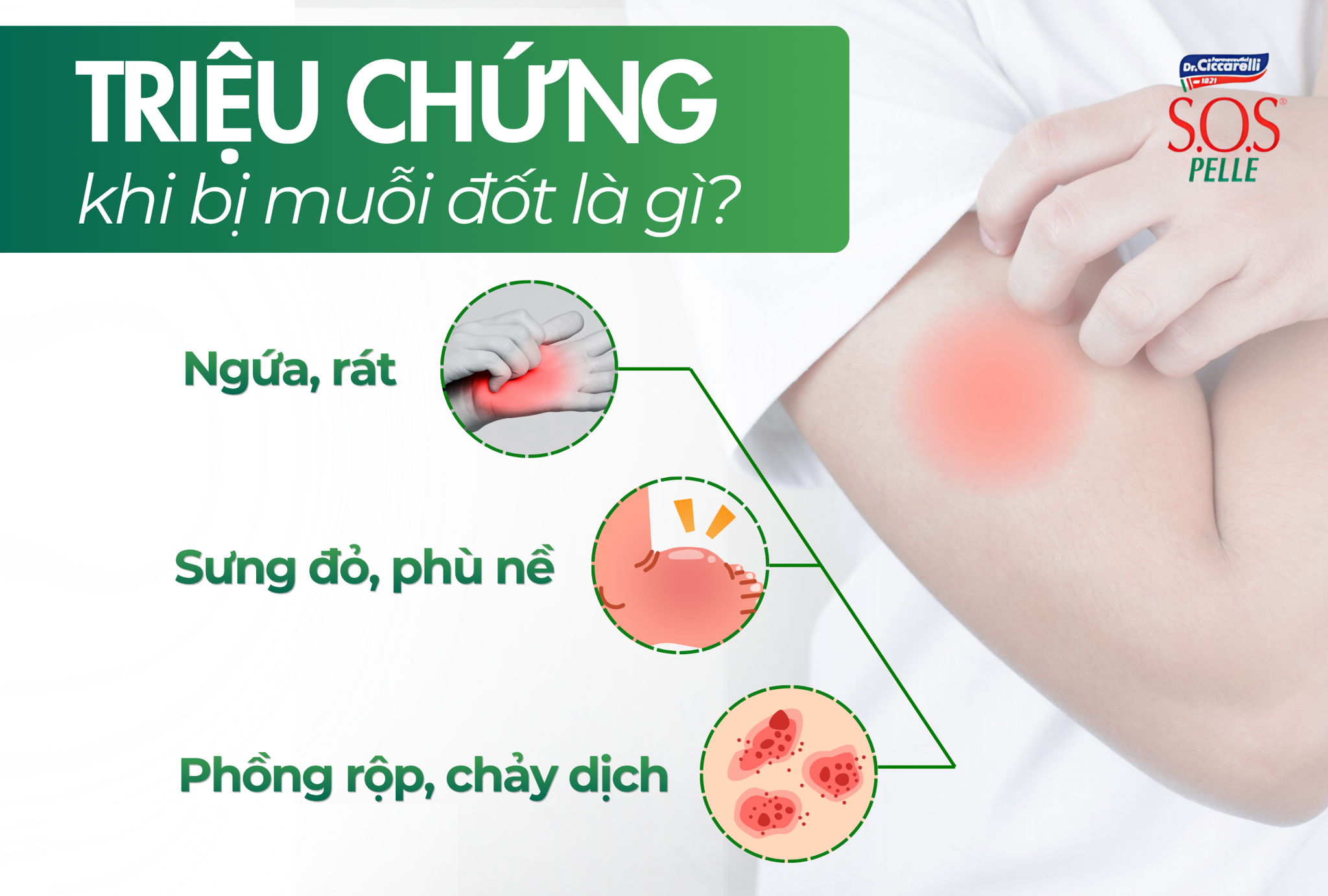 Triệu chứng khi bị muỗi đốt