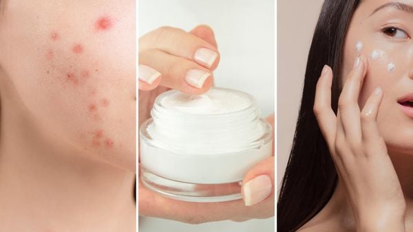 các bước skincare da mụn​