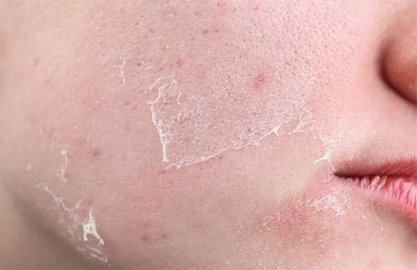 chăm sóc da sau peel