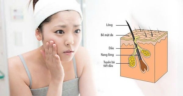 cách trị da nhờn