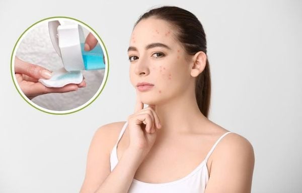 các bước skincare da mụn​