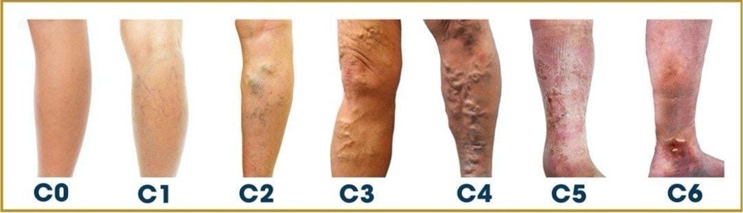 Cách chữa giãn tĩnh mạch tại nhà hiệu quả - Dụng cụ sẵn, dễ dàng áp dụng