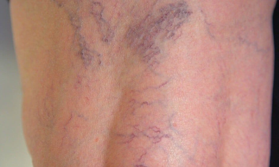 Chân nổi gân xanh là bị gì? Đừng chủ quan với bệnh lý nguy hiểm này!