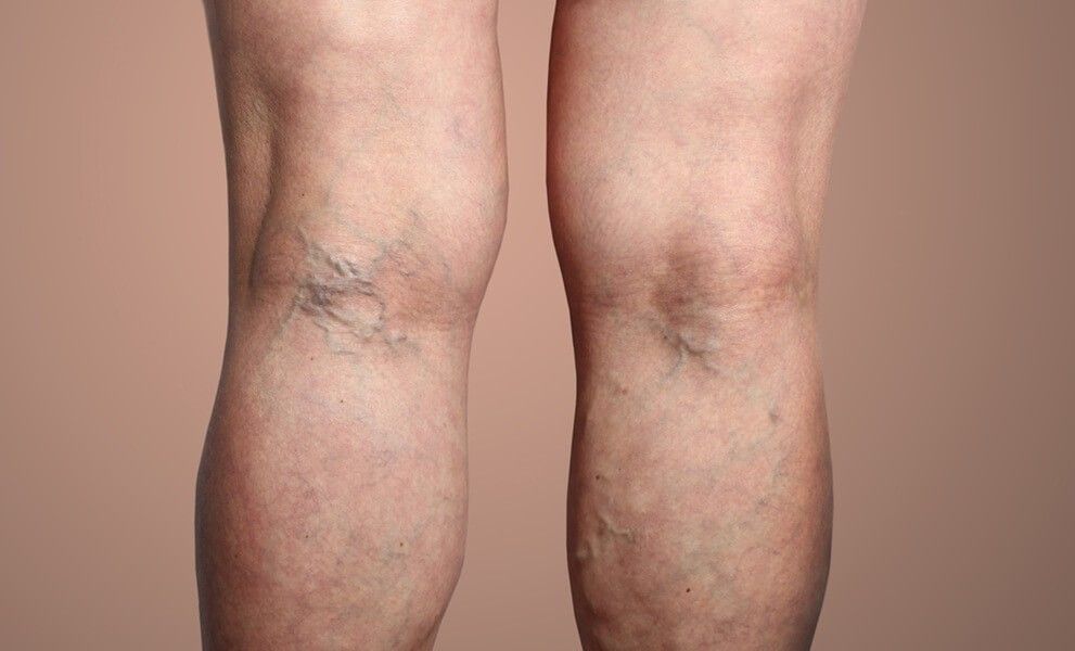 Người bị giãn tĩnh mạch có nên đi bộ không? Giải đáp và gợi ý các hoạt động tốt nhất cho người bệnh