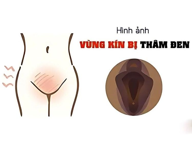 Vùng kín phụ nữ rất nhạy cảm và dễ bị tác động bởi nhiều yếu tố