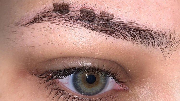 Da vùng xóa xăm bong vảy sau 3-5 ngày