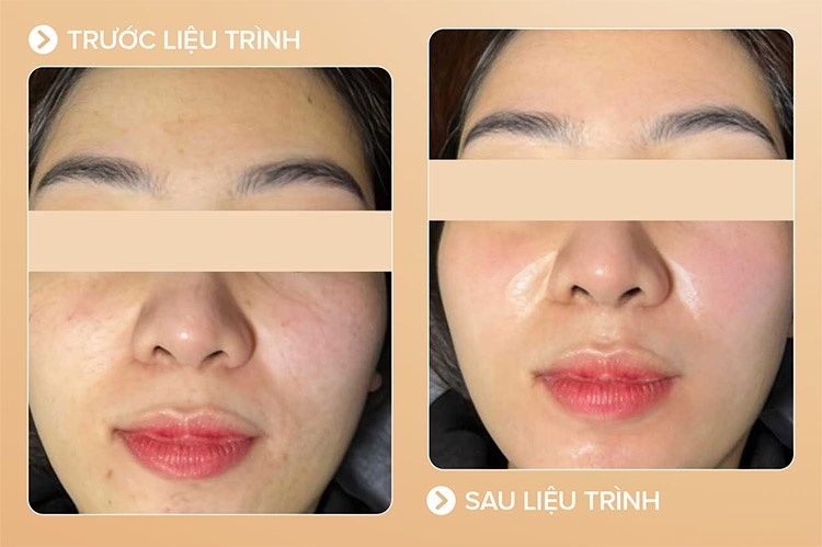 Hình ảnh khách hàng trước và sau liệu trình trẻ hóa da tại Beryl