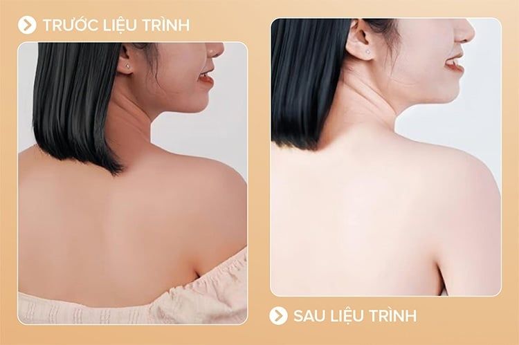 Da bật tông rõ rệt sau liệu trình đầu tiên tại Beryl Beauty & Spa