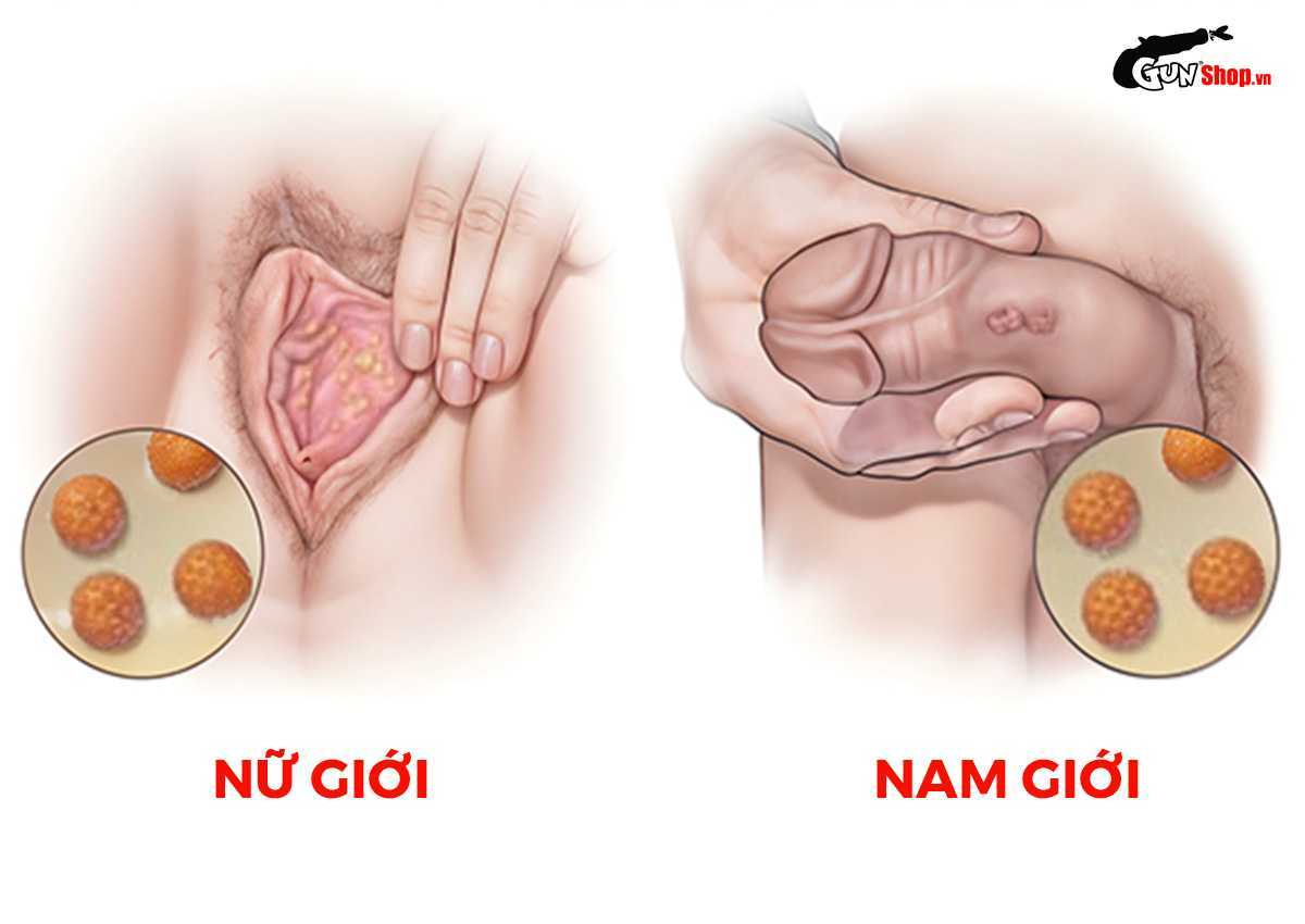 Đeo bao cao su có bị sùi mào gà không?