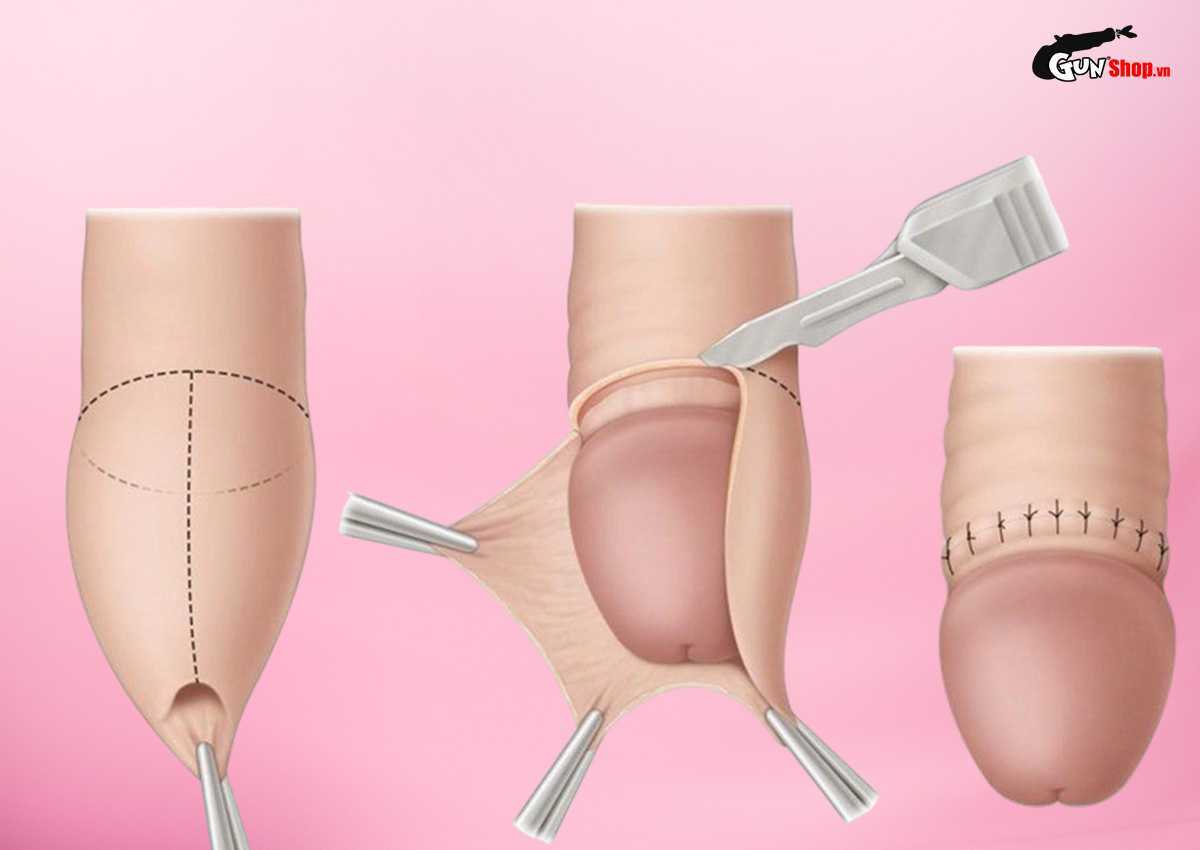 Dài bao quy đầu có quan hệ được không?