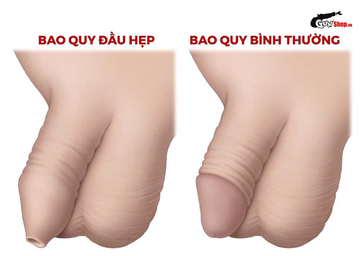 30 tuổi có nên cắt bao quy đầu không?