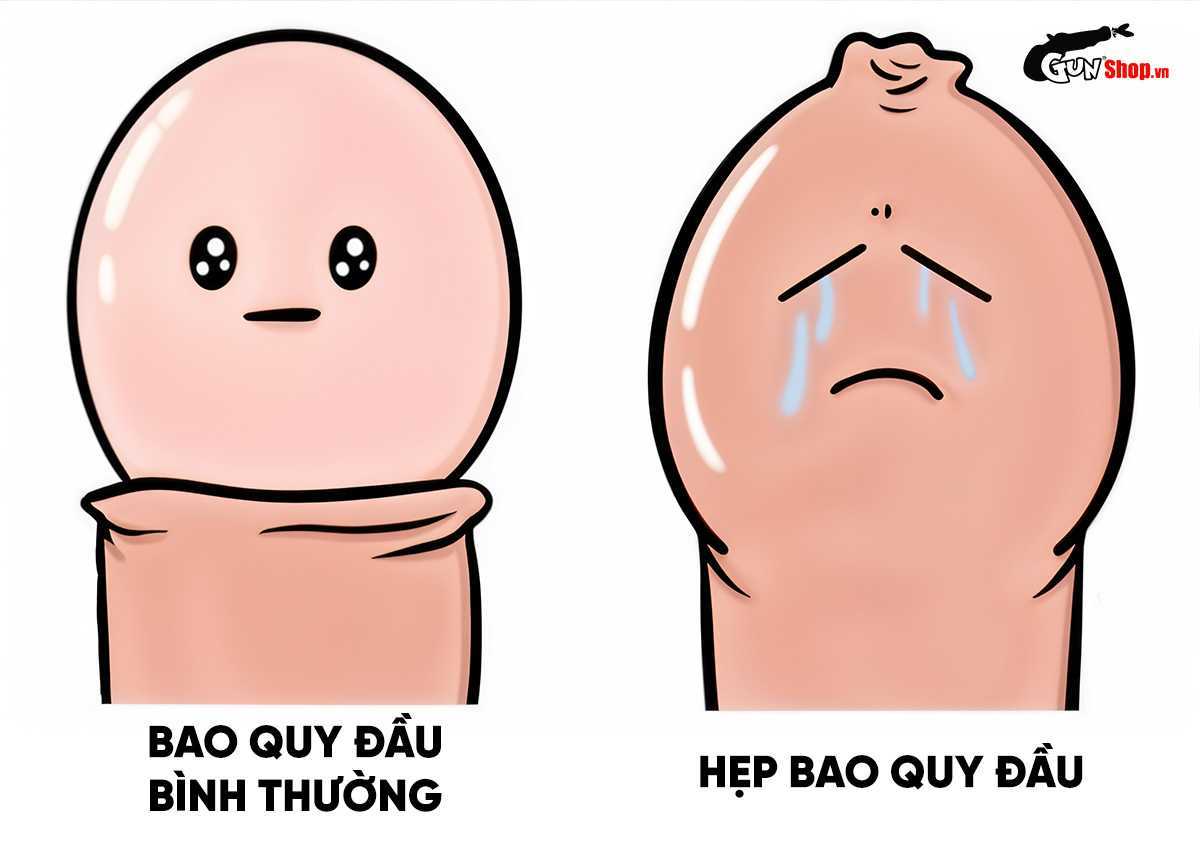 Hẹp bao quy đầu có đi nghĩa vụ quân sự được hay không?