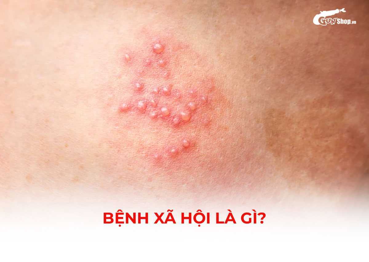 Bệnh xã hội là gì?