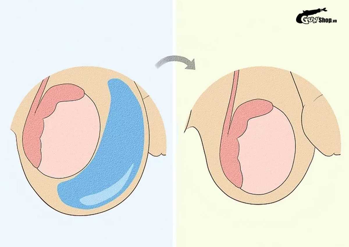 Tràn dịch màng tinh hoàn bao lâu thì khỏi?