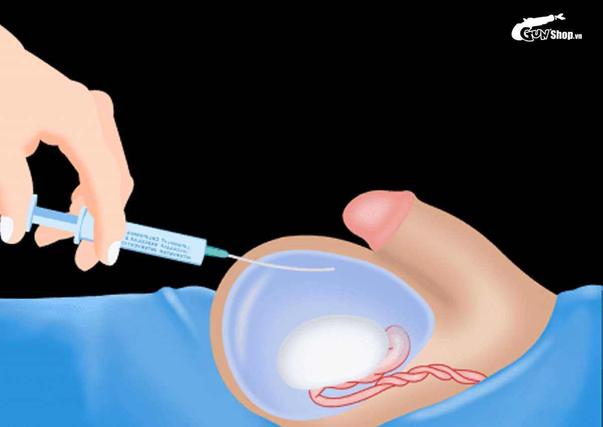 Tràn dịch màng tinh hoàn bao lâu thì khỏi?