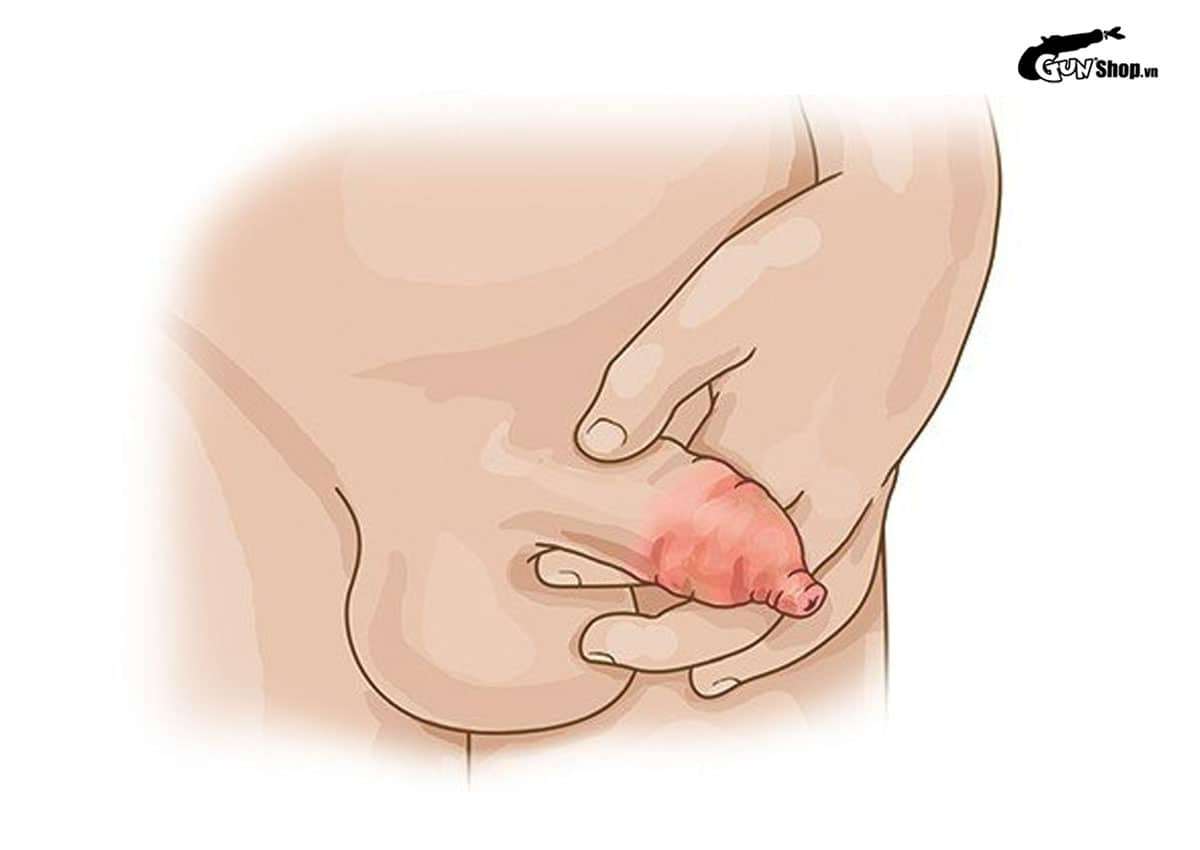 Chảy máu dương vật khi quan hệ có nguy hiểm không?