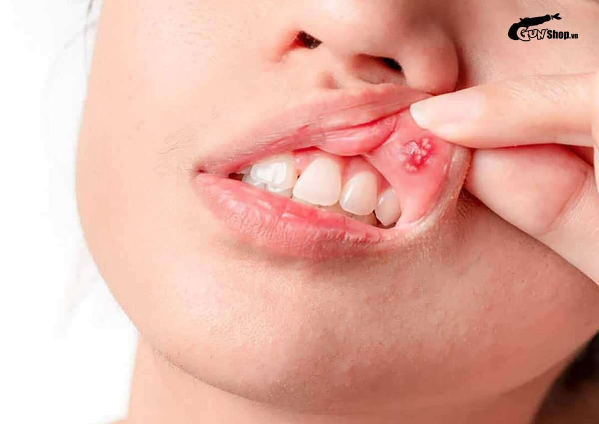 Nuốt tinh trùng có hết mụn không?