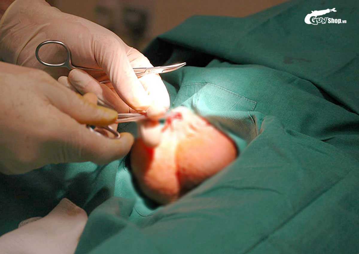 Thắt ống dẫn tinh rồi có nối lại được không?