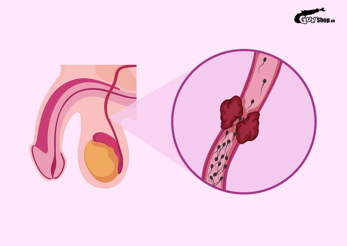 Tắc ống dẫn tinh kiêng gì để không làm bệnh nặng thêm?