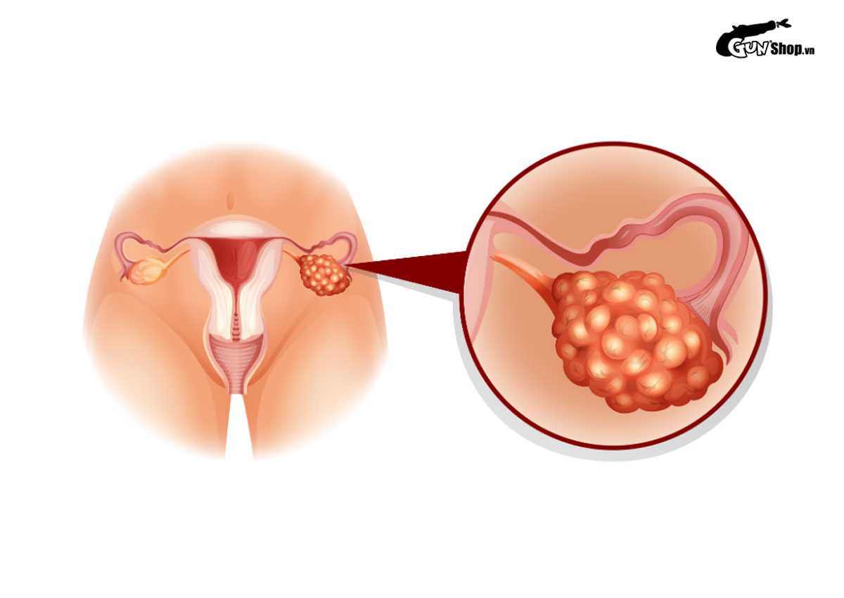 Tại sao vùng kín bị thâm?
