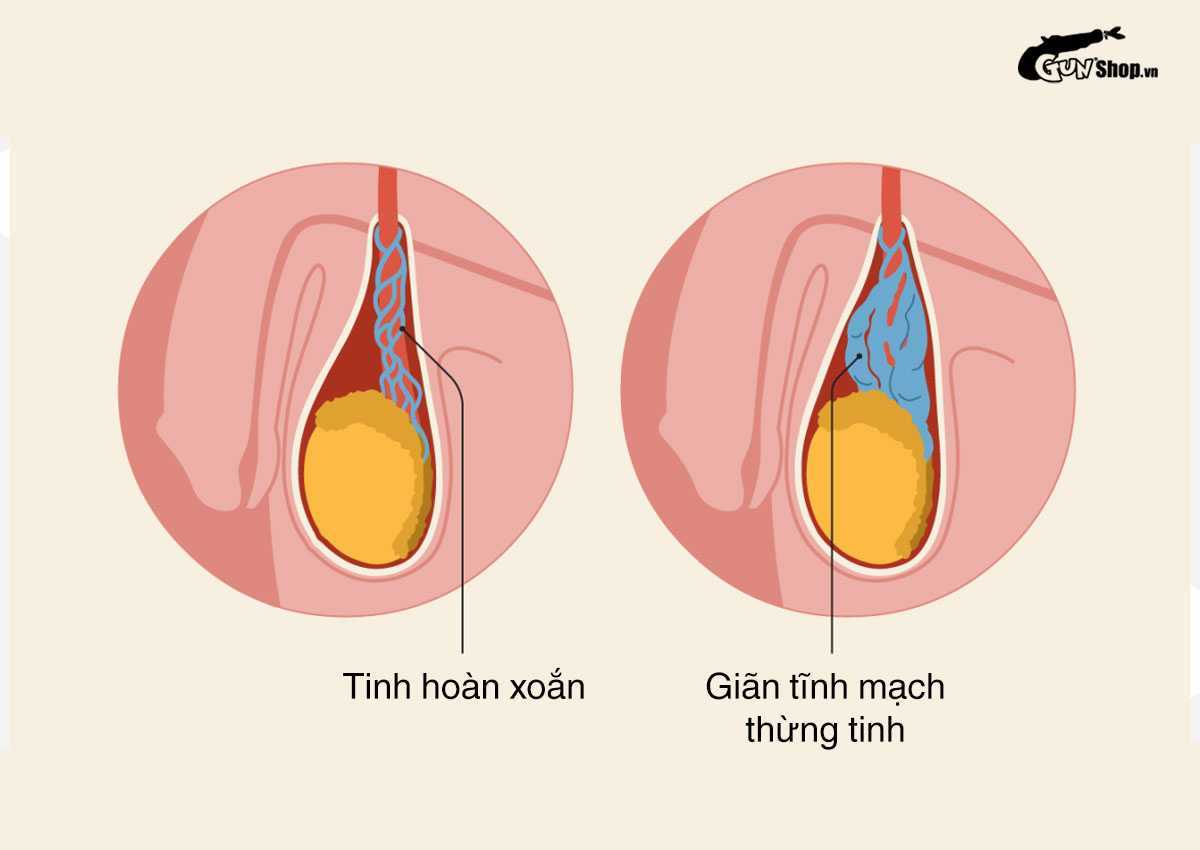 Tinh hoàn xệ có bị vô sinh không?